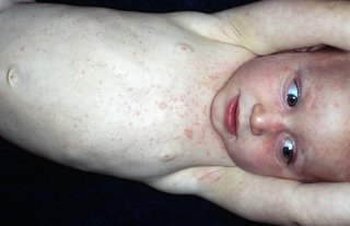 The roseola rash is made up of pinkish-red spots, patches or bumps