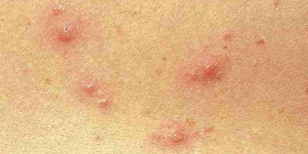 Симптомы ветрянки у детей и взрослых: Довольно часто на коже сразу появляются мелкие красные точки