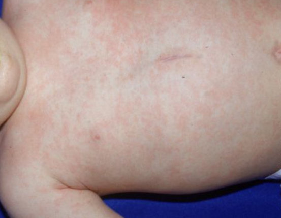 a baby with roseola rash in the chest and abdomen.image