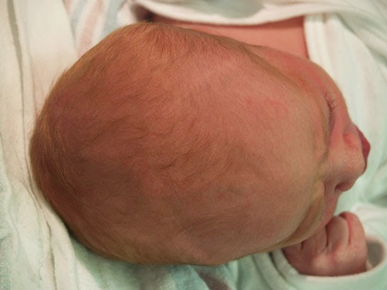 родовая гематома на голове у новорожденного