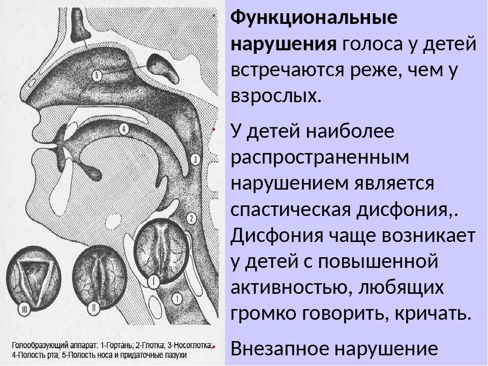 Осиплость голоса у ребенка. Функциональные нарушения голоса. Коррекция нарушений голоса у детей. Функциональные нарушения голоса у детей. Функциональные расстройства голосового аппарата.