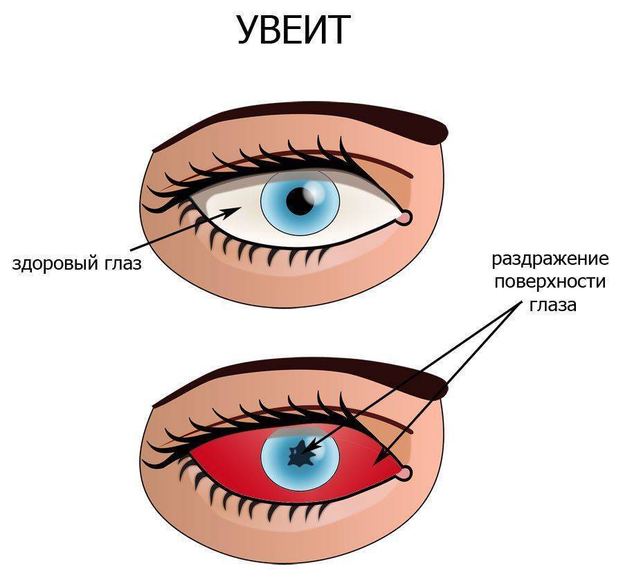 Как выглядит увеит на глазу