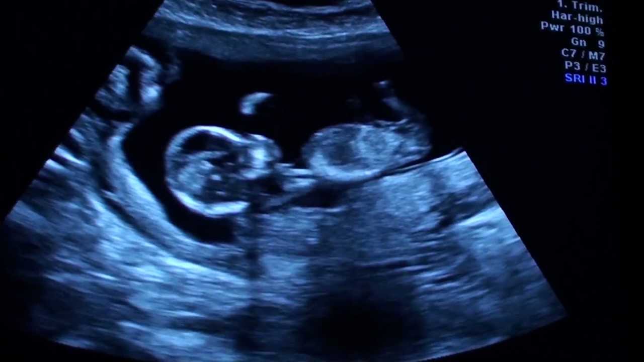 12 недель и 1 день. УЗИ 13 недель беременности двойня. УЗИ 13 недель беременности Близнецы. УЗИ 15 недель беременности двойня. УЗИ двойни на 14 неделе беременности.