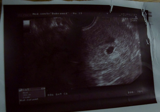 Когда можно увидеть беременность. Фото УЗИ беременности 3 недели двойня. УЗИ 4 недели беременности Близнецы. УЗИ двойняшек на 4 неделе беременности. УЗИ 6 недель беременности однояйцевыми близнецами.