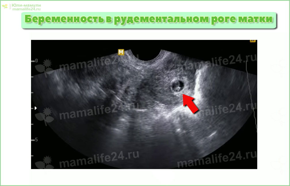 Беременность в роге матки