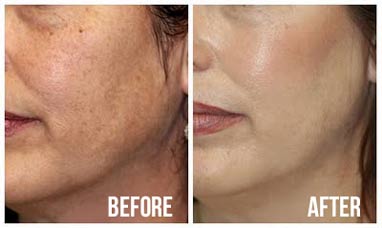 before after microdermabrasion