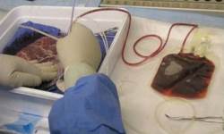 Technician drawing blood from the placenta by a technique called perfusion.