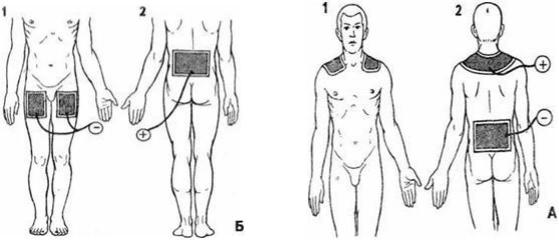 Электрофорез по разбитым зеркалом. Электрофорез лечебная гальванизация схема. Электрофорез и гальванизация на область желудка. Электрофорез схемы наложения электродов. Электрофорез при гастрите расположение электродов.