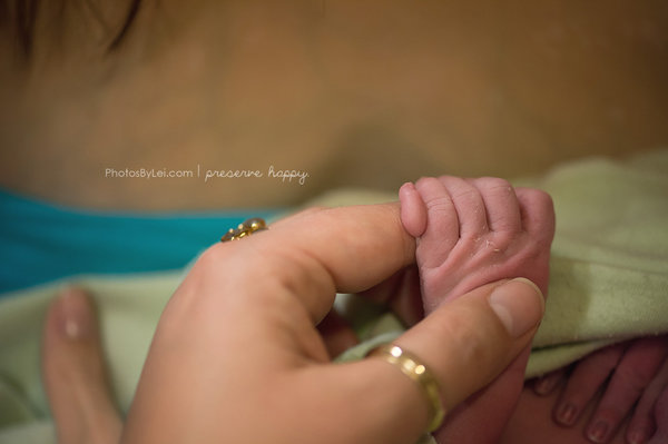 This baby is polydactyl, or born with a 6th finger on each hand