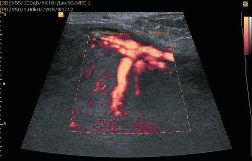 Эхограмма - сосудистое дерево при МДП, расширенные сосуды стволовых ворсин